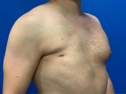 Poland Syndrome Before & After Patient #2131