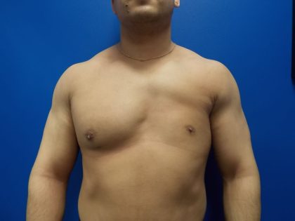 Poland Syndrome Before & After Patient #2121