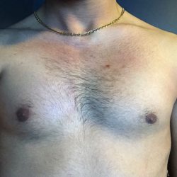 Poland Syndrome Before & After Patient #2123