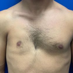 Poland Syndrome Before & After Patient #2123