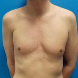 Poland Syndrome Before & After Patient #2125