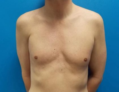 Poland Syndrome Before & After Patient #2125