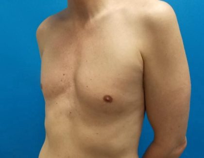 Poland Syndrome Before & After Patient #2125