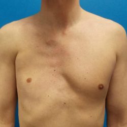 Poland Syndrome Before & After Patient #2125