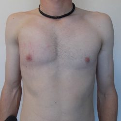 Poland Syndrome Before & After Patient #2126