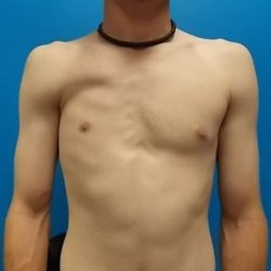 Poland Syndrome Before & After Patient #2126