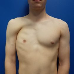 Poland Syndrome Before & After Patient #2127