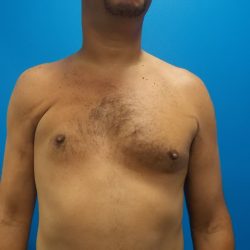 Poland Syndrome Before & After Patient #2128
