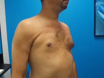 Poland Syndrome Before & After Patient #2128