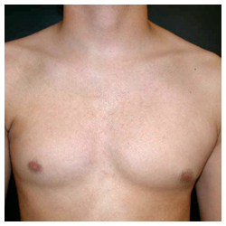 Poland Syndrome Before & After Patient #1045