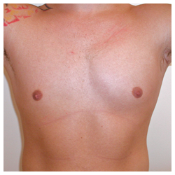 Poland Syndrome Before & After Patient #1047