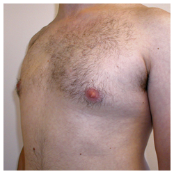 Poland Syndrome Before & After Patient #1048