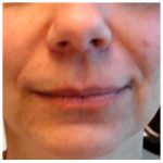 Restylane Before & After Patient #1069