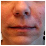 Restylane Before & After Patient #1069