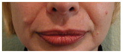 Restylane Before & After Patient #1068