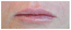Restylane Before & After Patient #1077