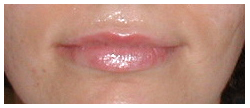 Restylane Before & After Patient #1073