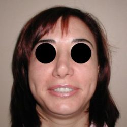 Rhinoplasty Before & After Patient #2138