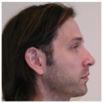Rhinoplasty Before & After Patient #1012