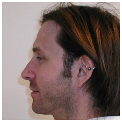 Rhinoplasty Before & After Patient #1012