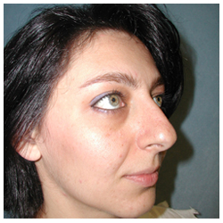Rhinoplasty Before & After Patient #1007