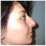 Rhinoplasty Before & After Patient #1007