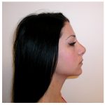 Rhinoplasty Before & After Patient #1009