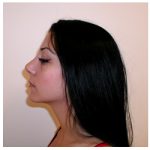 Rhinoplasty Before & After Patient #1009
