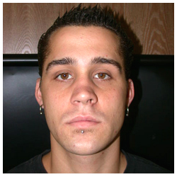 Rhinoplasty Before & After Patient #1010