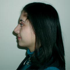 Rhinoplasty Before & After Patient #1008