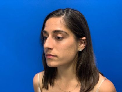 Rhinoplasty Before & After Patient #2133