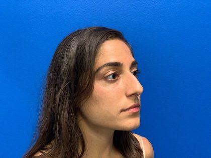 Rhinoplasty Before & After Patient #2133
