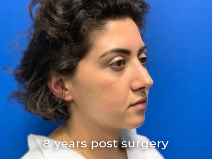 Rhinoplasty Before & After Patient #1008
