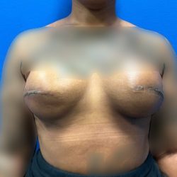 Tissue Expander To Implant Breast Reconstruction Before & After Patient #2067
