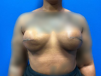 Tissue Expander To Implant Breast Reconstruction Before & After Patient #2067