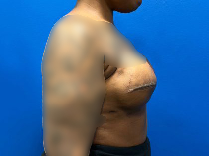 Tissue Expander To Implant Breast Reconstruction Before & After Patient #2067