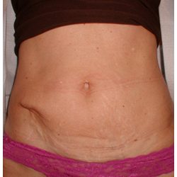 Tummy Tuck Before & After Patient #1050