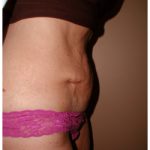 Tummy Tuck Before & After Patient #1050