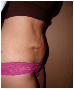 Tummy Tuck Before & After Patient #1050