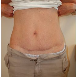 Tummy Tuck Before & After Patient #1050