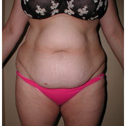 Tummy Tuck Before & After Patient #1052
