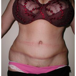 Tummy Tuck Before & After Patient #1052