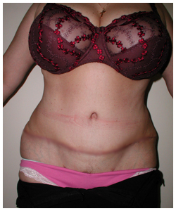 Tummy Tuck Before & After Patient #1052
