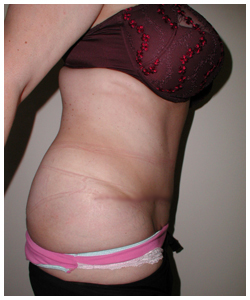 Tummy Tuck Before & After Patient #1052