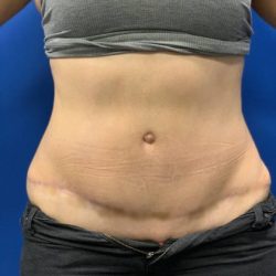 Tummy Tuck Before & After Patient #2139