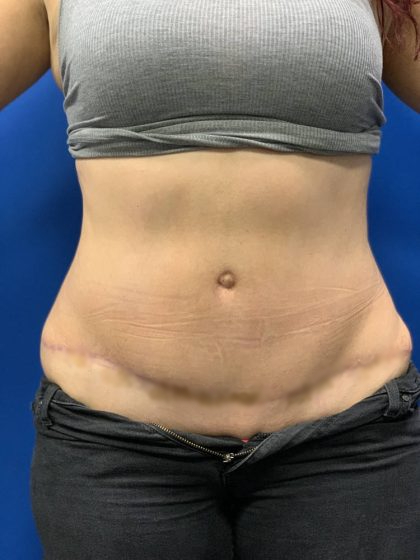 Tummy Tuck Before & After Patient #2139