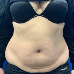 Tummy Tuck Before & After Patient #2139
