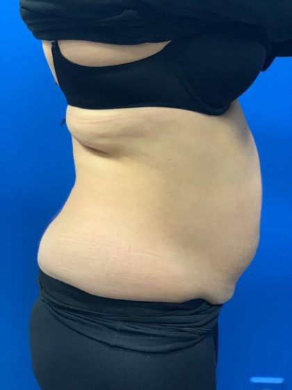 Tummy Tuck Before & After Patient #2139