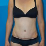Tummy Tuck Before & After Patient #2140