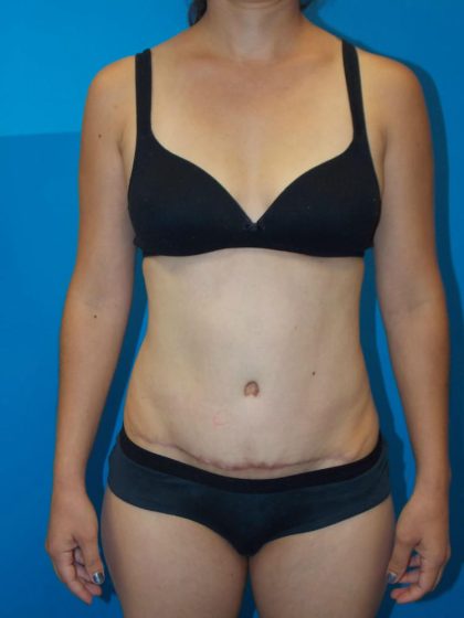 Tummy Tuck Before & After Patient #2140